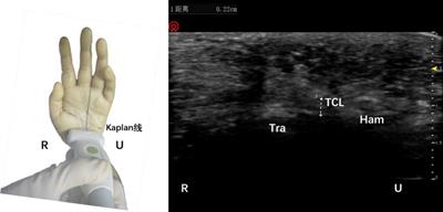 Ultrasound-guided percutaneous release procedures in the transverse carpal ligament by acupotomy: A cadaveric study